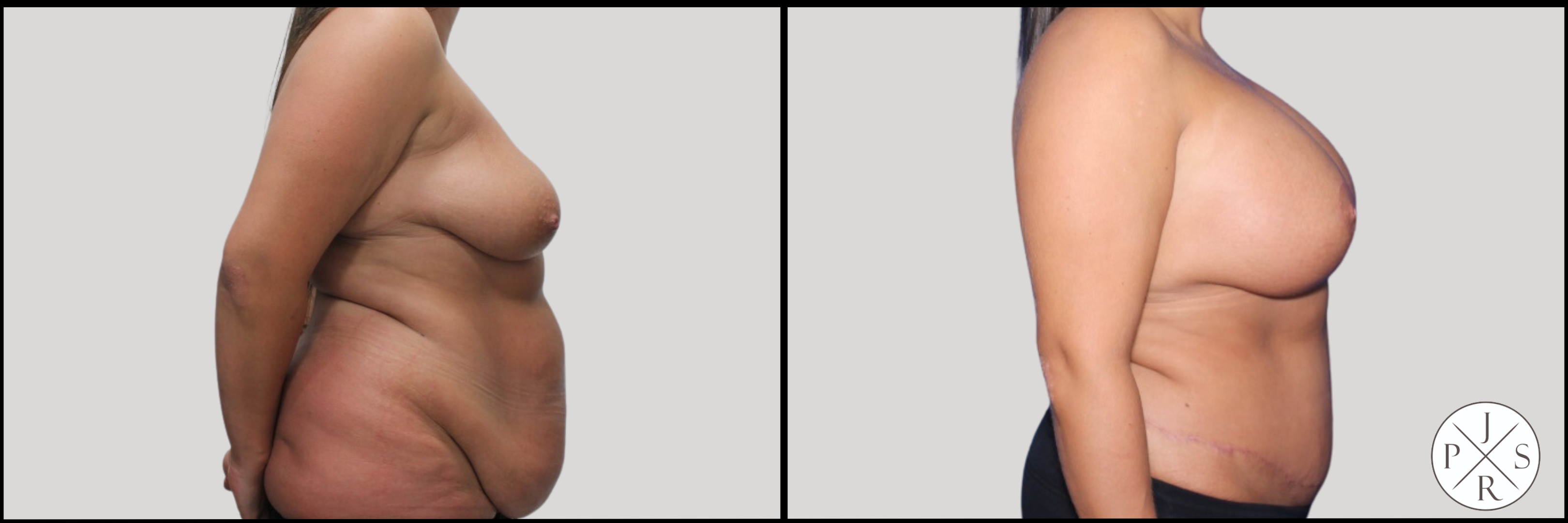 Abdominoplasty Before & After Image